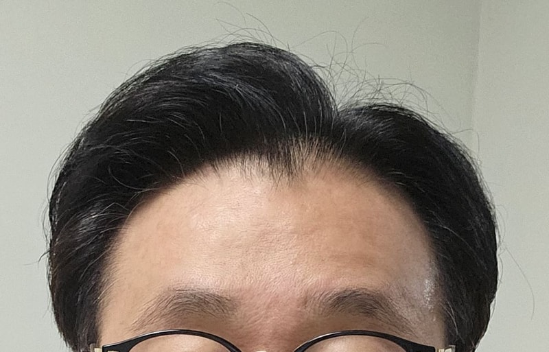 10년차 탈모, 목표는 결혼! 압구정 포헤어 비절개슬릿 모발이식 수술당일 후기 (민영기 원장님)