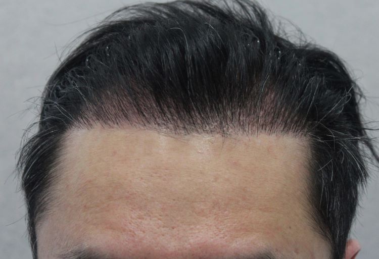 수술 3개월.jpg