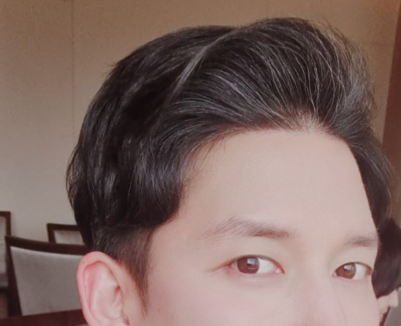 압구정 포헤어 변화과정 (수술일-암흑기-6개월차 변화과정 / 비절개모발이식(슬릿)+정수리약복용)