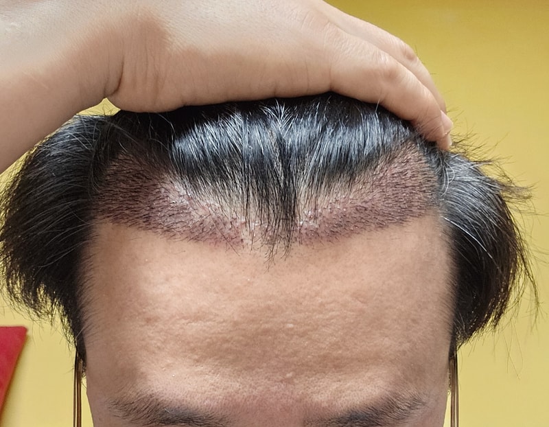 압구정모발이식2.jpg