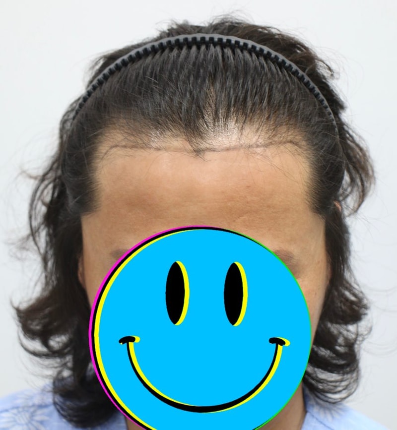 포헤어 Forhair 100일 병원 경과 후기입니다
