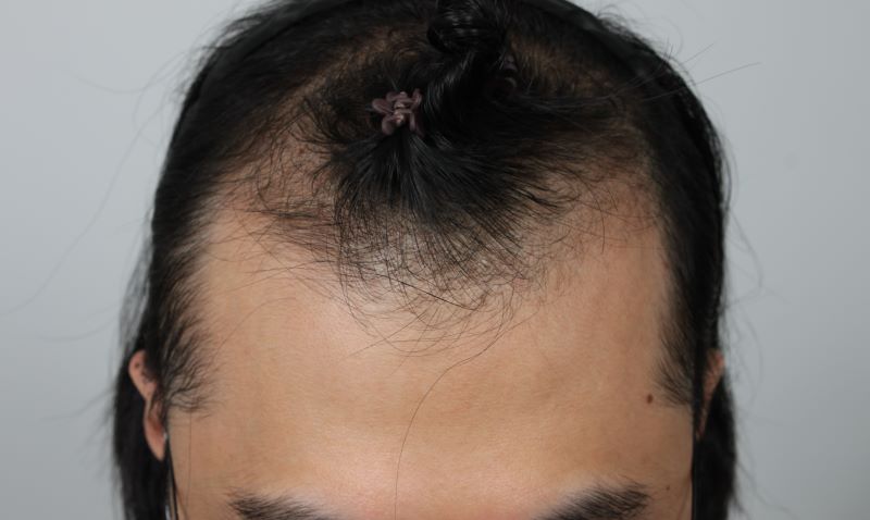 1.수술전.JPG