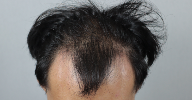 Men's MJ hair loss 3,800 woolen hair, left a review of the 2nd week