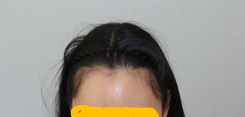 어제 엠자탈모 모발이식하고왔어요