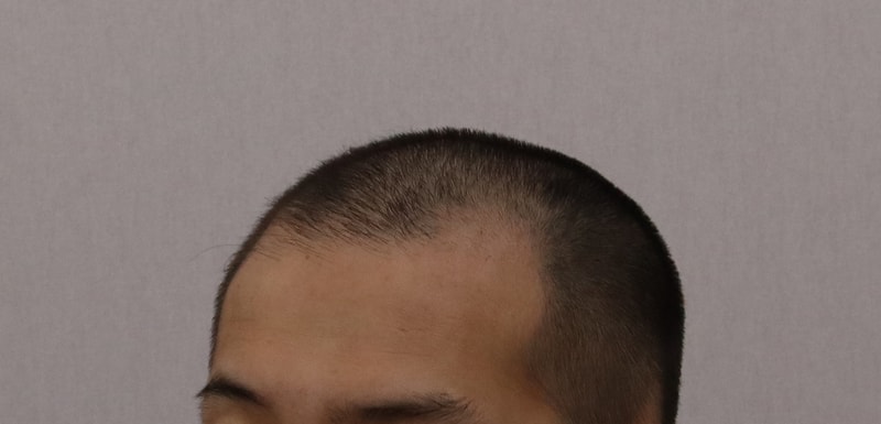 시술전2.jpg