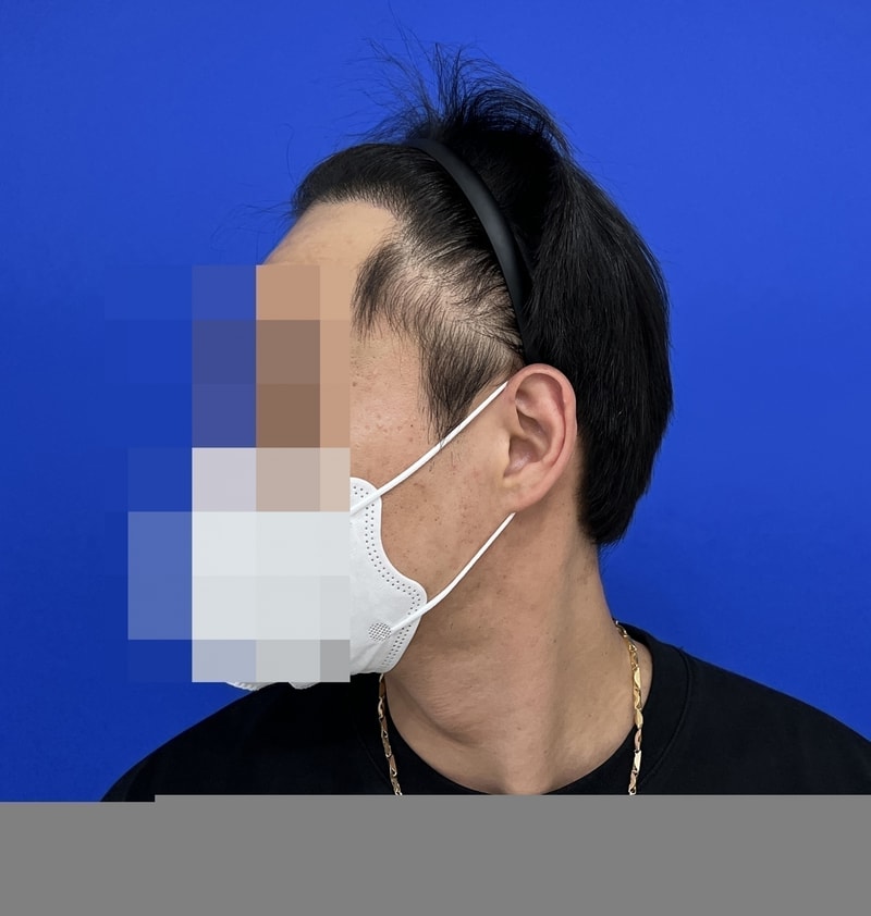 수술9m후 1 복사.jpg