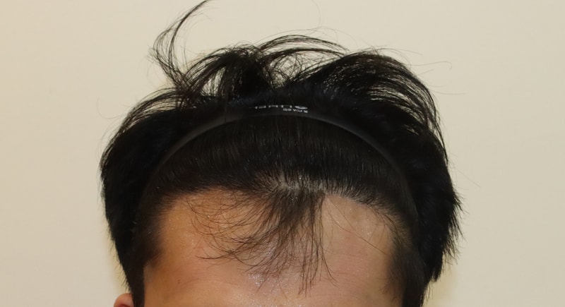 This is the first year review of M-shaped hair loss incision 3800 Mo