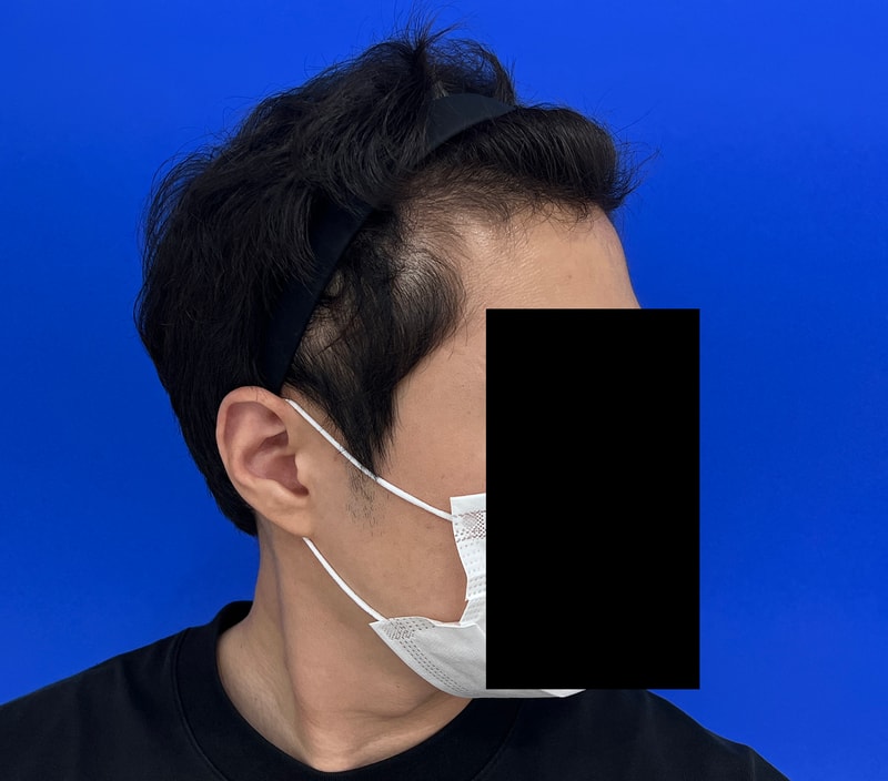 M자 1500모, 정수리 1500모 모발이식후기입니다