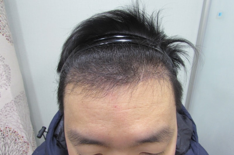 6개월경과.jpg