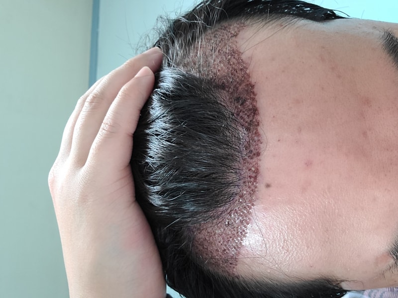 1500 Hair follicle (3000 Hair) Non-cut