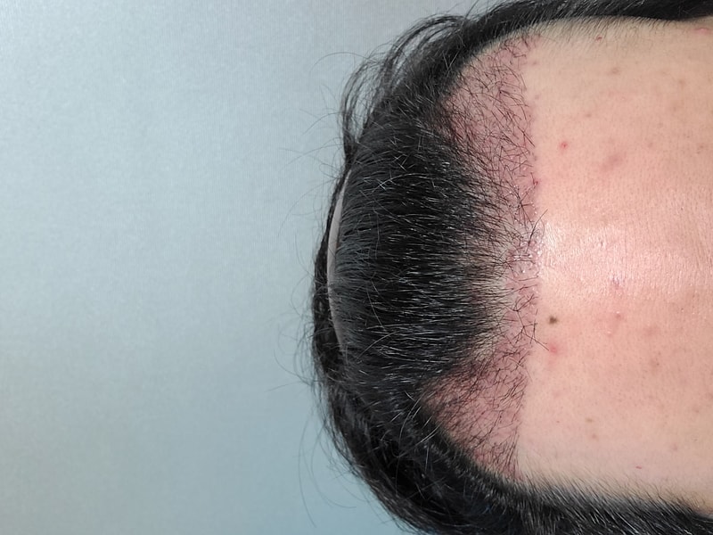 [Motion] 1500 hair follicles (3,000 hair) Non-cut - 1 month old