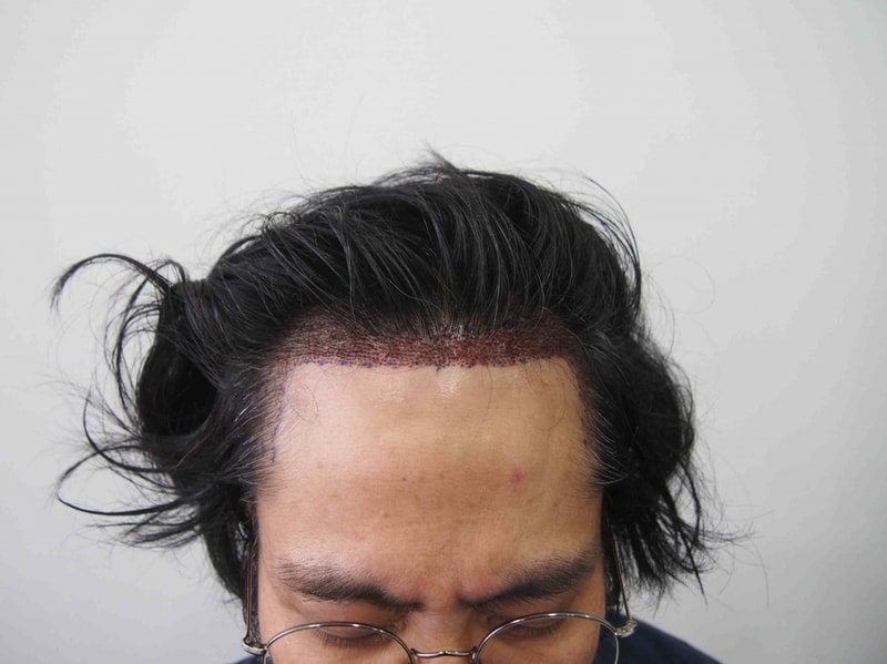 수술후 1.JPG