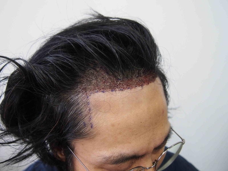 수술후 2.JPG