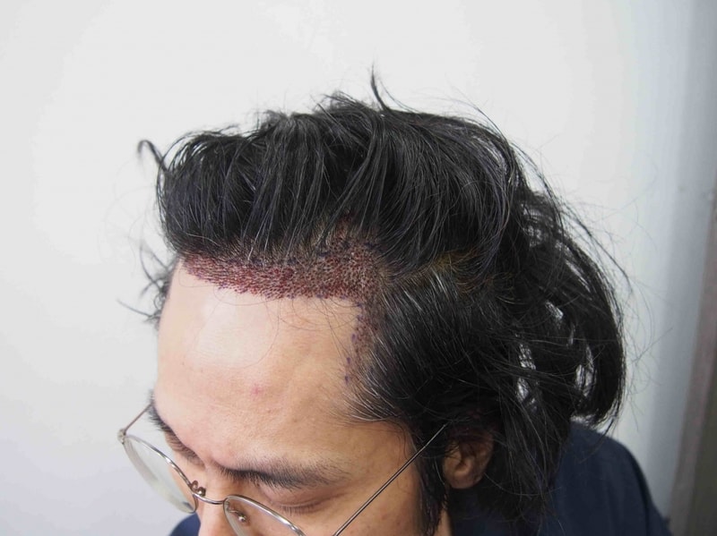 수술후 3.JPG