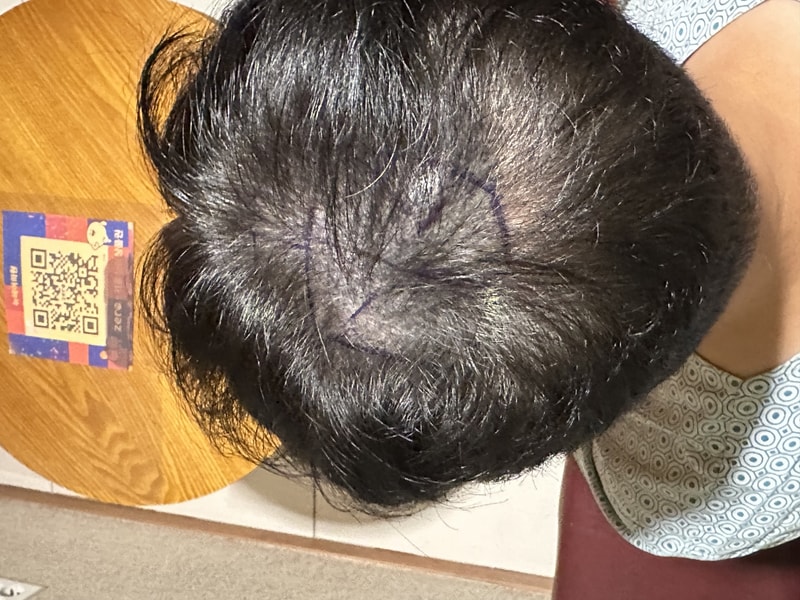 This is the review of the incision Hair Transplant on the 3rd day of New Hair. I did 1,500 hair follicles. Second round