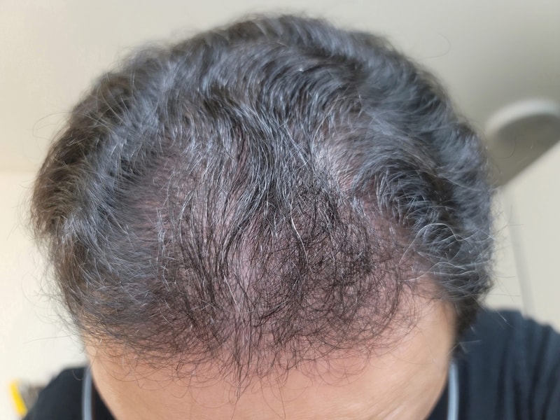 비절개 모발이식 후기 입니다. (4개월)