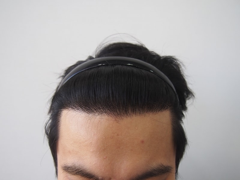 수술 후 정면.jpg