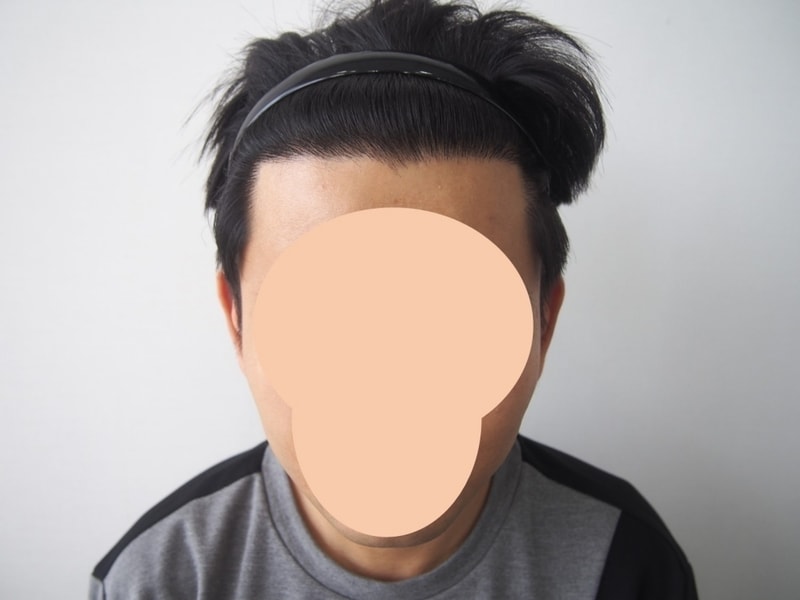 모재성, 비절개, 부분삭발, 990모낭(M자 이마라인)+160모낭(구렛나루), 8개월