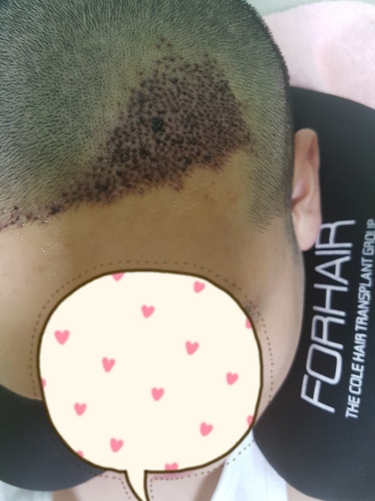 1250모낭 8개월차..  평가부탁드립니다. 아....