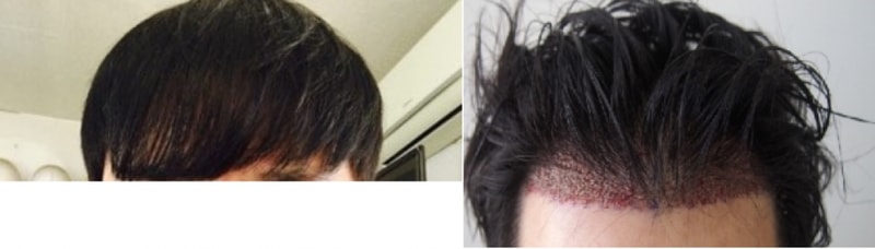 이식전.png