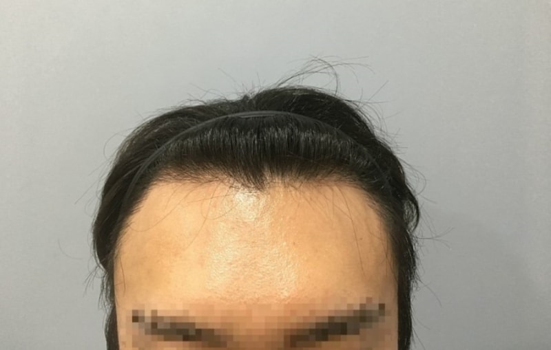 다나 절개 4000모-헤어라인+구렛나루 수정+정수리+뒷머리절개흉터