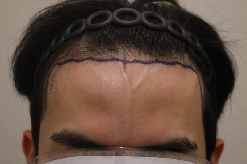 ドンタンヘアで医院1ヶ月経過 非切開植毛2200本の手術後の体験談