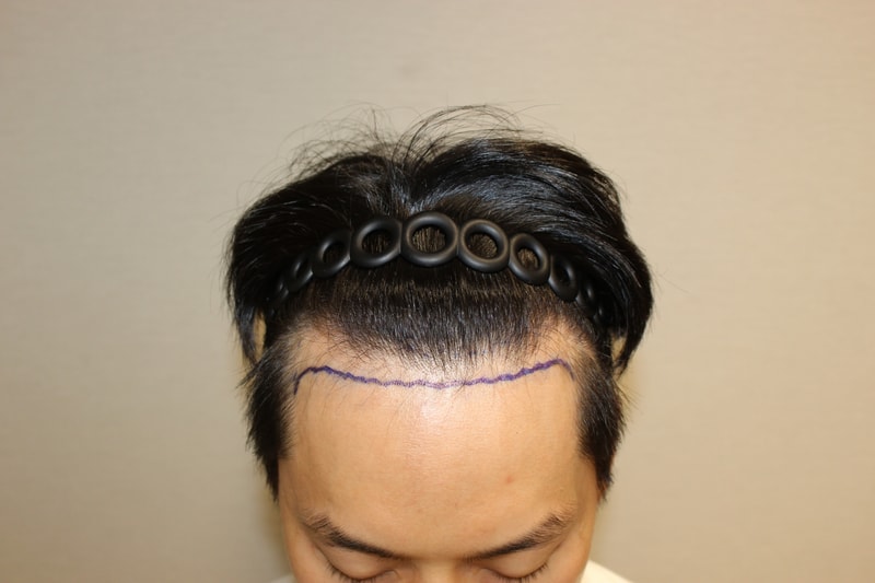 수술전앞.jpg