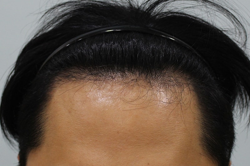 수술후 3개월 (2).JPG