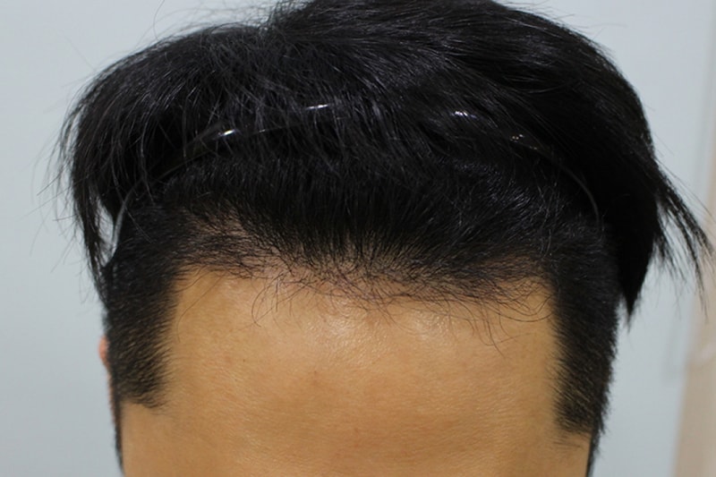 수술후5개월 (3).JPG