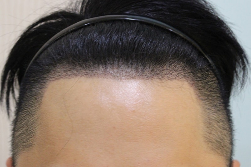 수술후 10일째 (2).JPG