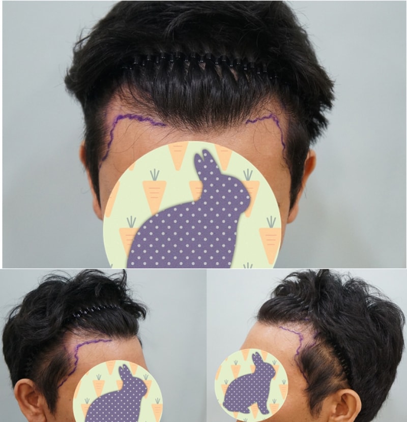 수술전 디자인.jpg