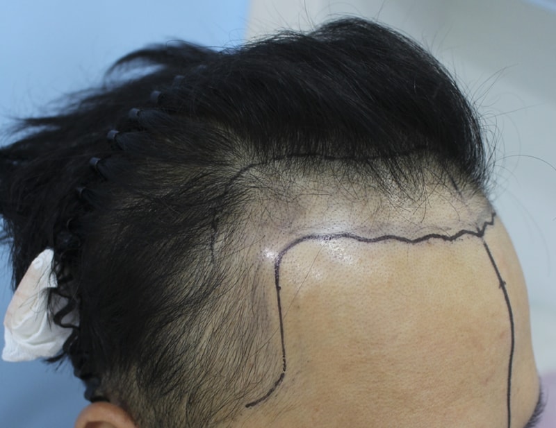 머리카락 이식을 한지 7개월도 훌쩍 넘었어요....