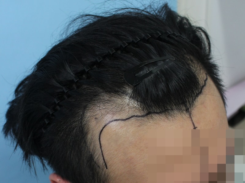 수술전 디자인 (2).jpg