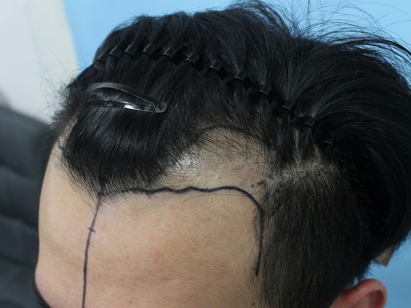 수술전 디자인 (3).jpg