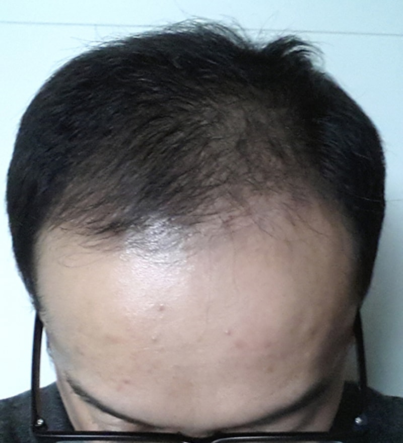 모발이식 수술 후.jpg