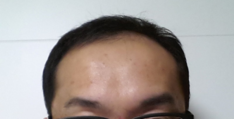모발이식 수술 후 정면.jpg