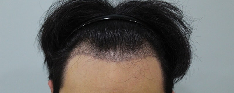 수술후 10일 (3).JPG