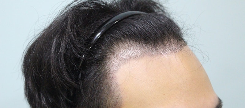 수술후 10일 (1).JPG