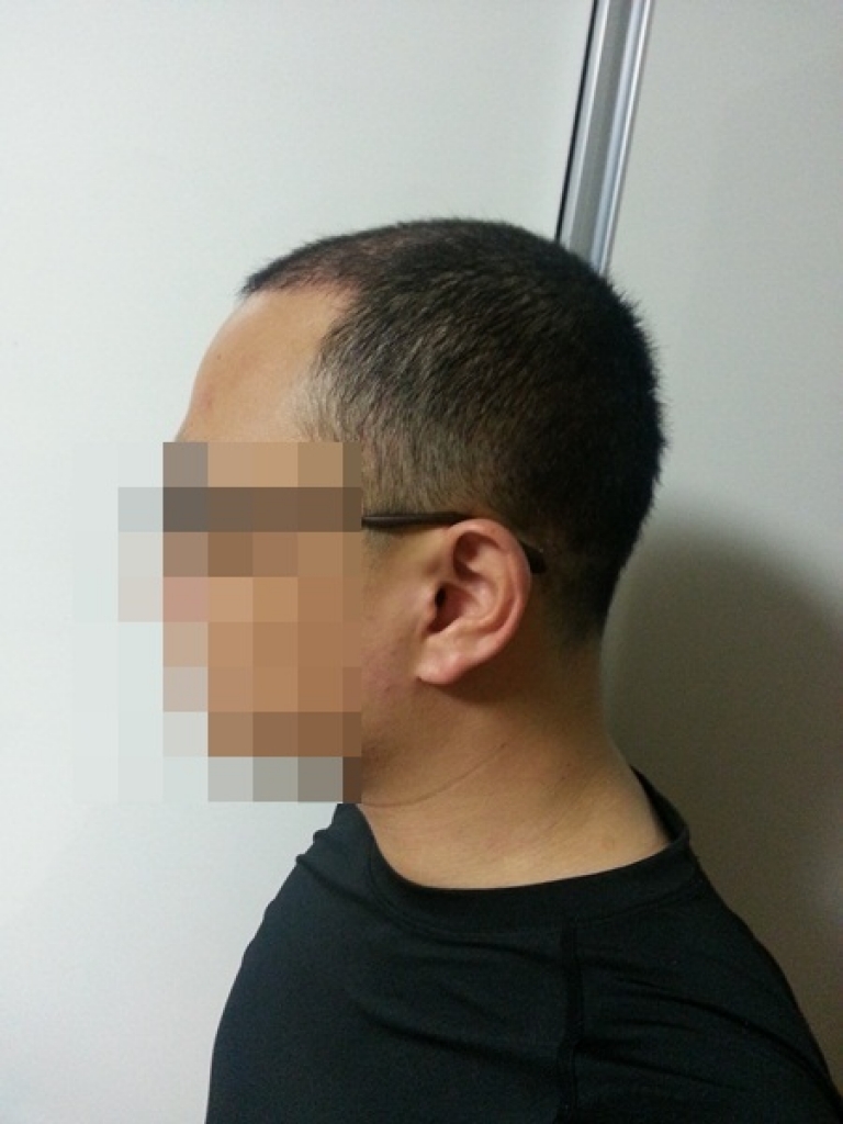 다나 비절개 3000모낭......2개월 후 신기하기만 했던 변화...