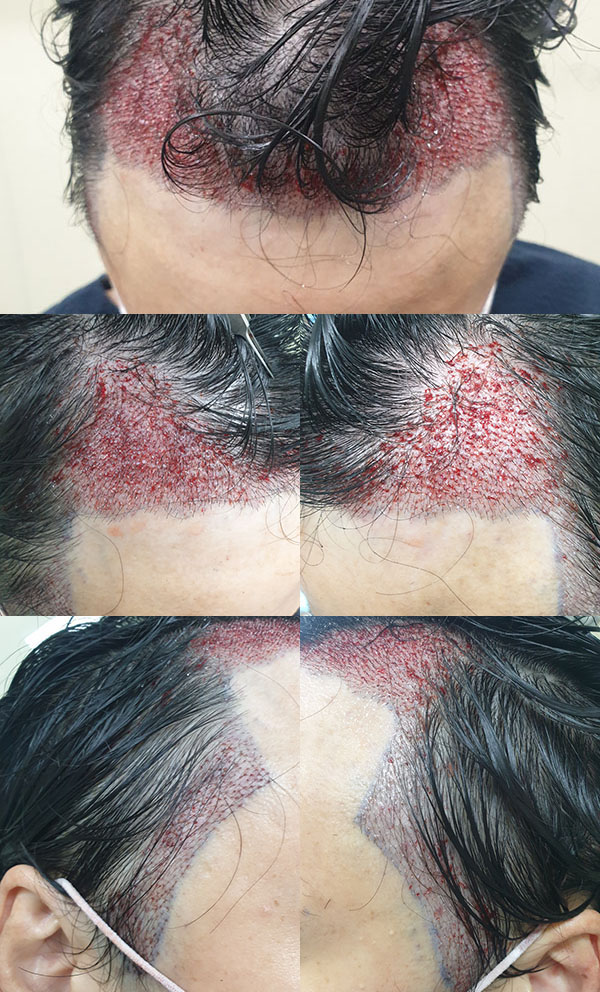 6 수술 직후.jpg