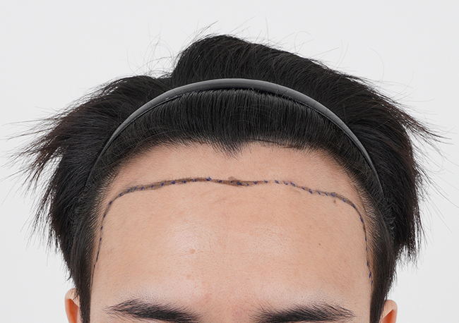 Momo's Daegu branch incision 4,500 Mo's monthly review