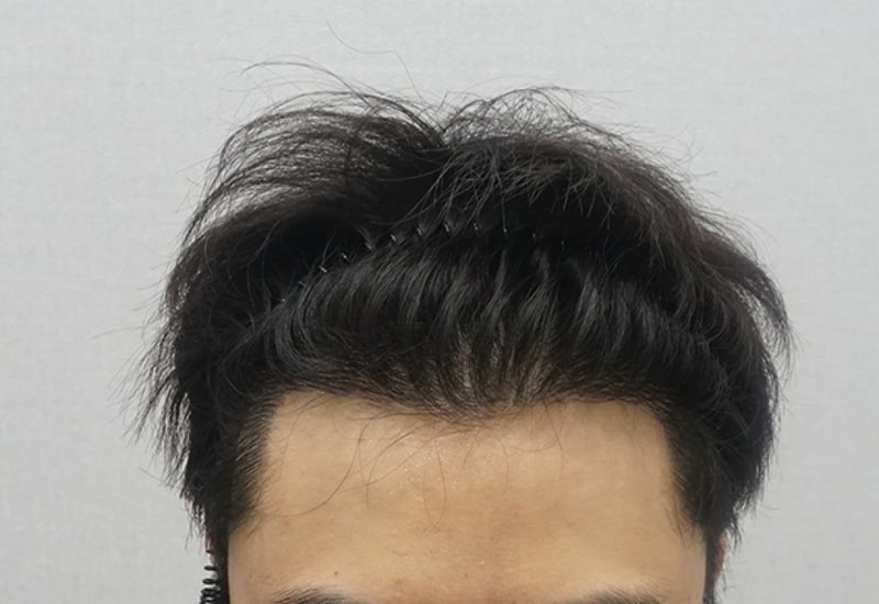 수술후_2.jpg