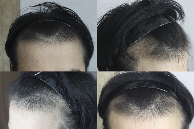 3800모 절개 3개월 조금 넘었어요