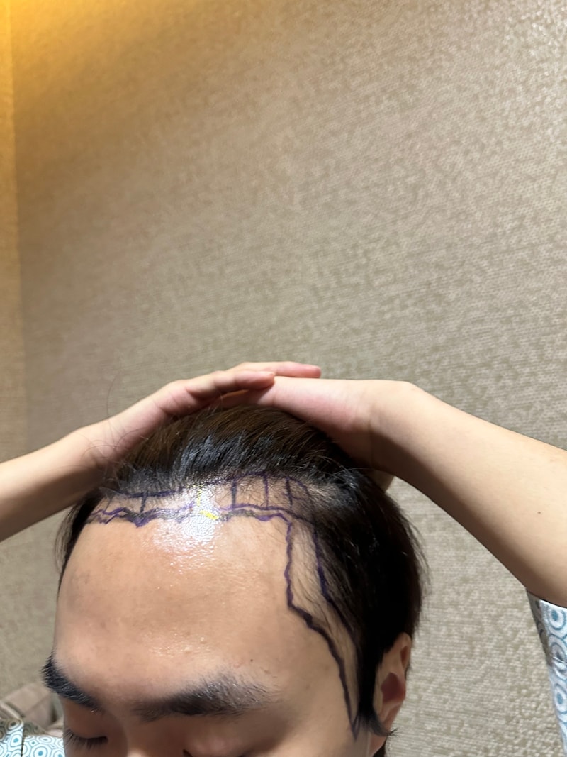 New Hair Hair Plastic Surgery Hair Transplantation Non-Cutting 2000 Hair Orthography 6 Months Late