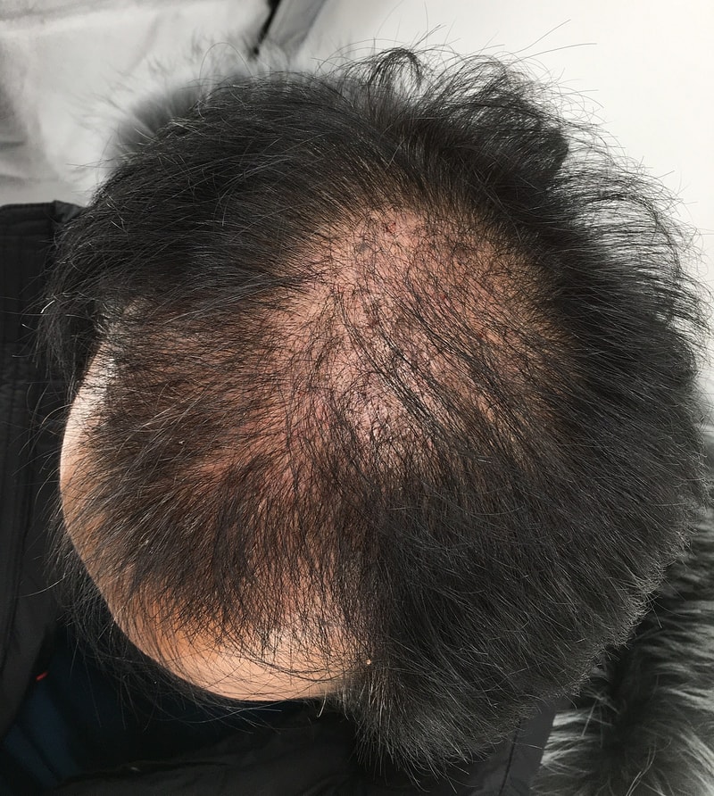 모발이식수술 2500모낭 6개월차 후기