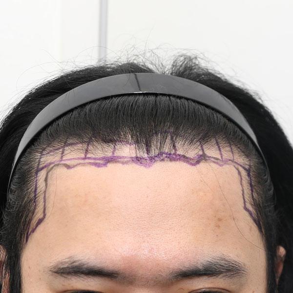 뉴헤어 모발이식 비절개 2000모낭 9개월차 후기