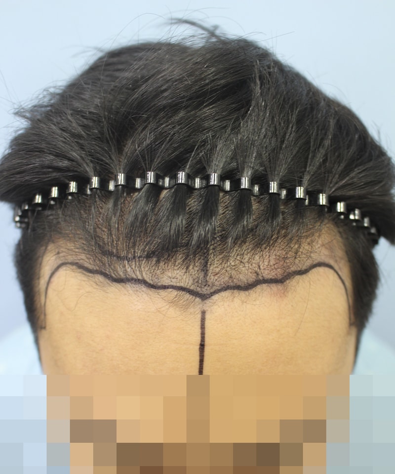 이식을 하고 왔는데 후기 올려봅니다