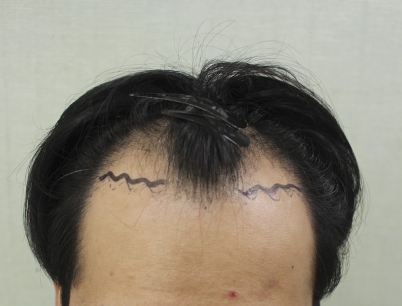 제가 이식을 한지도 벌써 5개월이네요 (절개3500모)