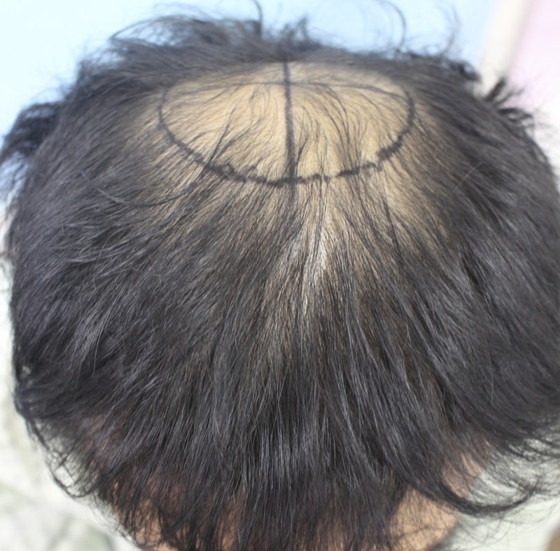 정수리 절개 4200모한지 6개월이 되었습니다