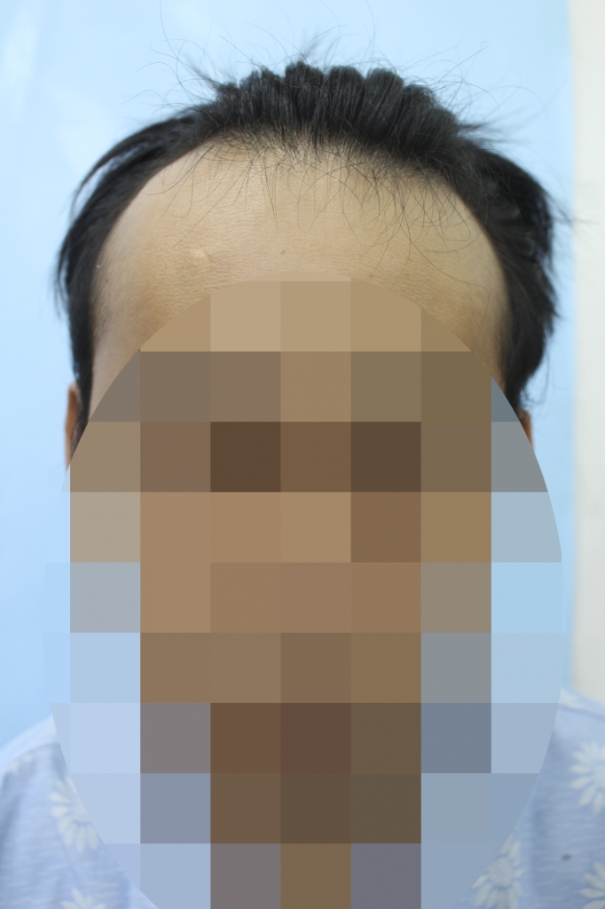 M자+옆선 절개 3000모 했습니다
